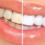 Отбеливание зубов лимоном – голливудская улыбка в домашних условиях. Как отбелить зубы лимоном и содой безопасно