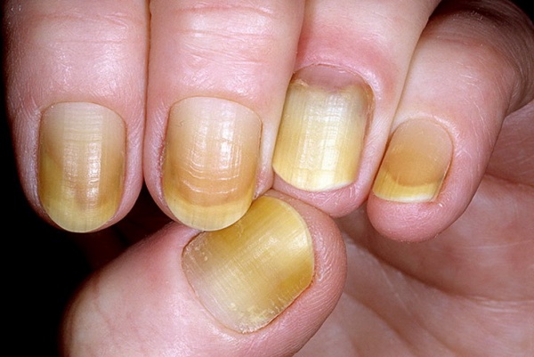 желтые ногти