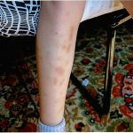 Синяки на ногах: почему появляются и что с этим делать. Какие лекарства и народные средства помогут избавится от синяков на ногах