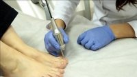 Лазеротерапия грибка ногтей