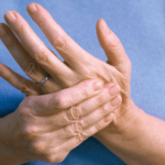 Отекают руки (кисти, пальцы) — причины, симптомы, лечение. По какой причине отекают руки и какое лечение самое эффективное.