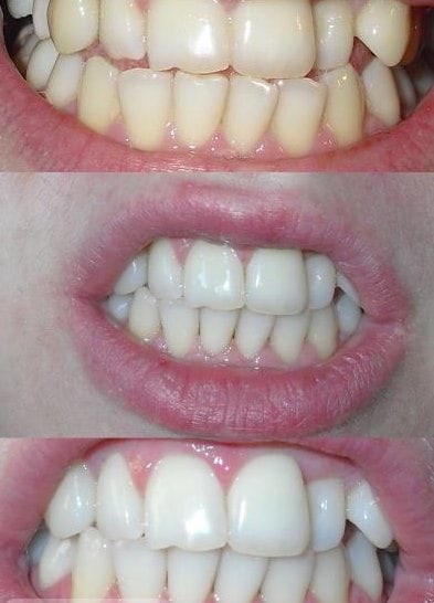 отбеливание зубов маслом отзывы