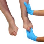 Как лечить шишку большого пальца стопы?