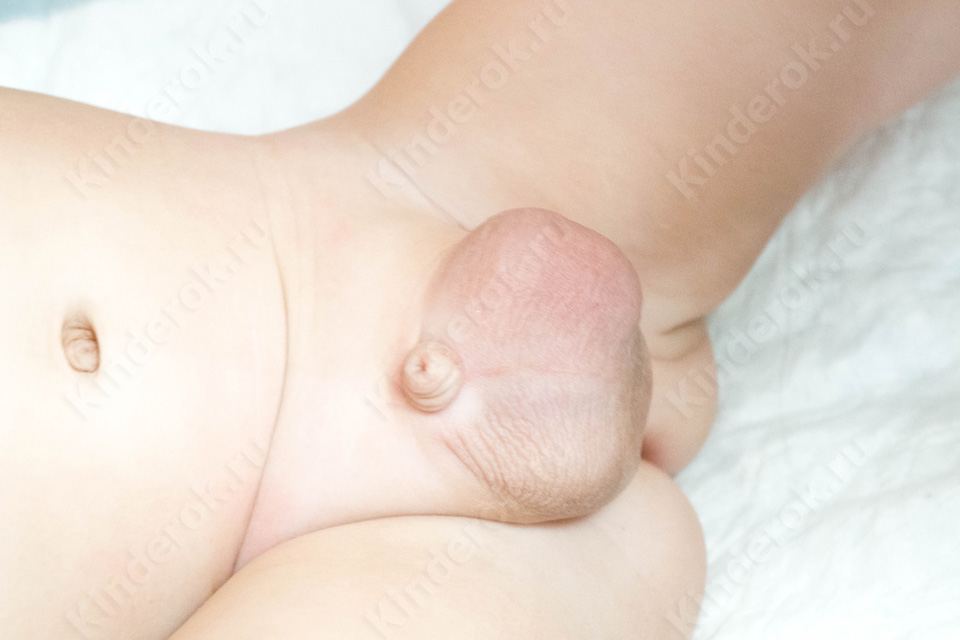 Левосторонняя пахово-мошоночная грыжа у грудного ребенка