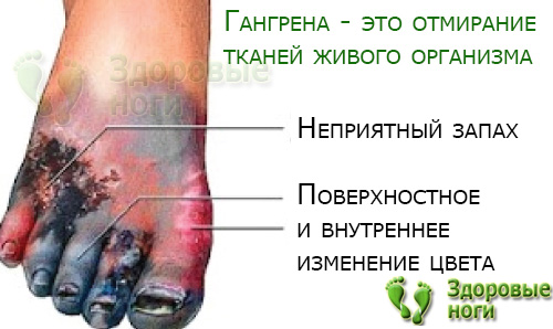 Если при диабете почернел палец на ноге, то вскоре это может развиться в гангрену