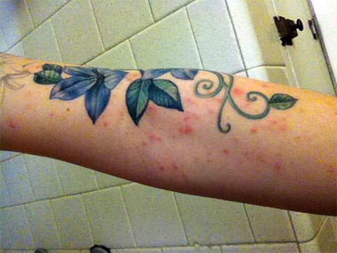 Типичная аллергия на краску для татуировки