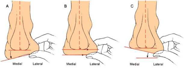 Схемы деформации стопы: вальгусная, варусная и нормальная