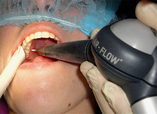 При отбеливании зубов по технологии Air-Flow полностью удалить зубной камень удается не всегда.