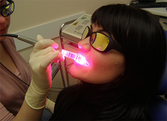 Лазерное отбеливание зубов по своей сути является химическим, а лазер используется лишь как активатор перекисных соединений.