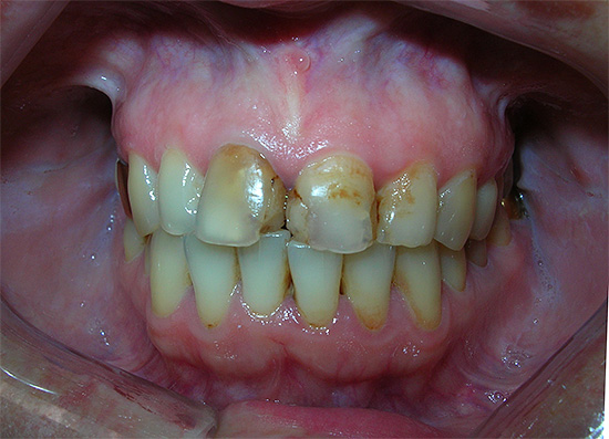 Наличие старых пломб при химическом способе отбеливания зубов может привести к затеканию геля в микротрещины, что иногда вызывает сильнейшие боли.