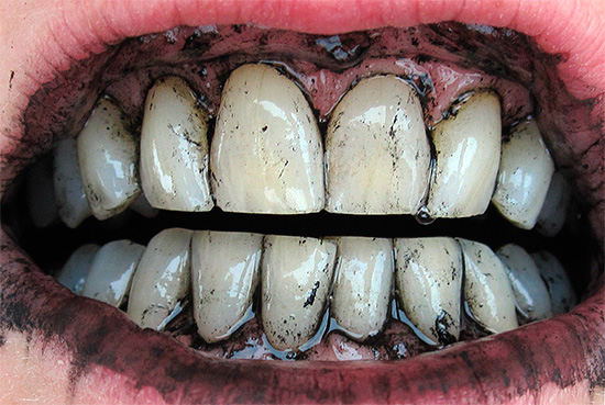 Отбеливание зубов активированным углем довольно редко бывает эффективным.