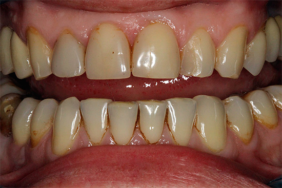 При обилии зубного камня и налета целесообразно будет провести профессиональную гигиену полости рта - это сразу же сделает зону улыбки белее.