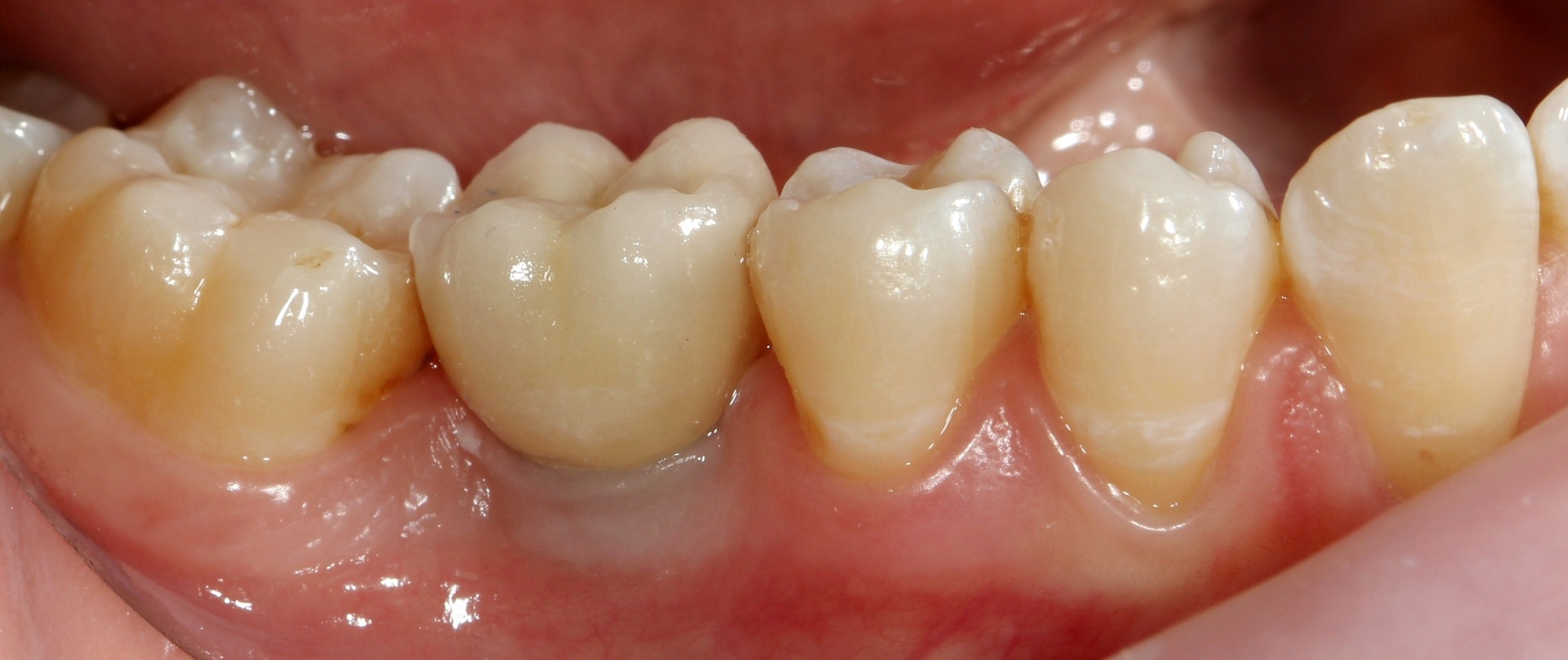 На фотографии показан пример обильного зубного камня на передних нижних зубах.