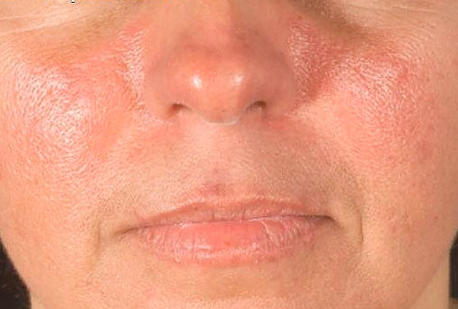 Характерная сыпь на лице - «бабочка»
