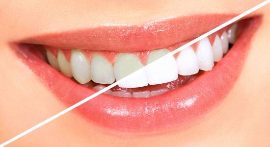 как отбелить зубы в домашних условиях