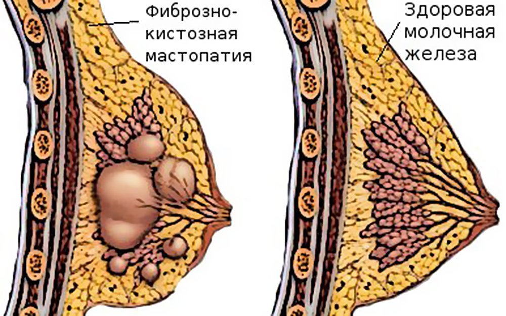 фиброзно кистозная мастопатия после 60 лет