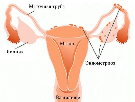 endometrios 