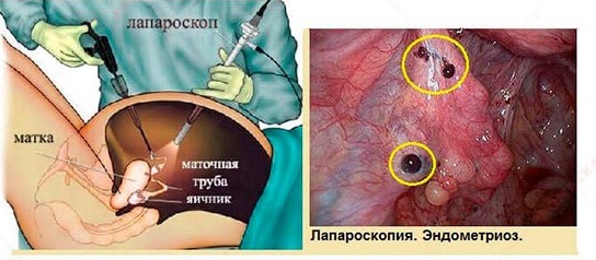 Desinflamar el vientre después de laparoscopia