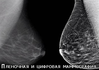 пленочная и цифровая маммография