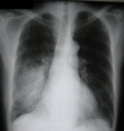 Рентгеновское исследование при пневмонии