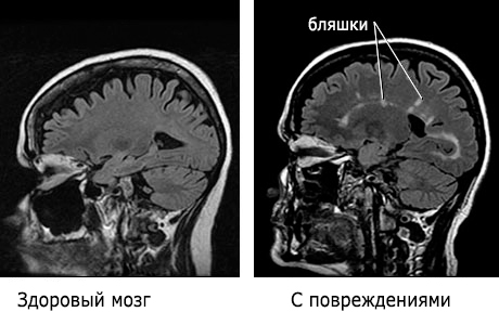 Мозг при рассеянном склерозе