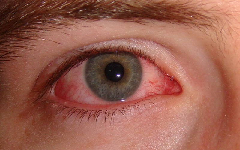 Красота глаз требует внимания – иногда они могут стать красными после процедуры