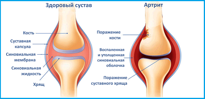 Артрит колена