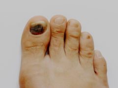 Появились темные пятна на ногтях больших пальцев ног: причины, что делать?