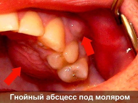 Гнойный абсцесс зуба