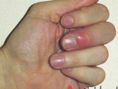 Что делать если палец у ногтя болит, гноится, происходит воспаление и каковы причины