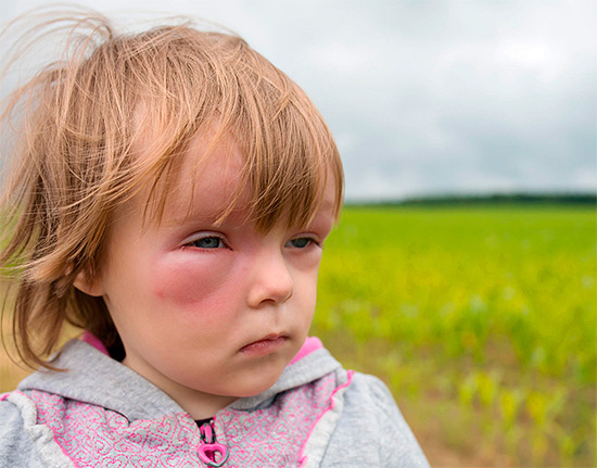 При оказании первой помощи ребенку следует помнить, что многие препараты от аллергии не предназначены для приема в детском возрасте.