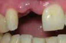 Виды протезирования передних зубов