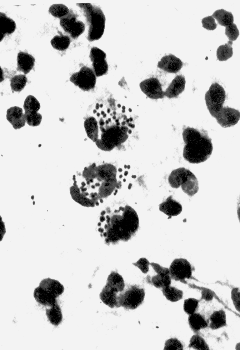 МРис. 1. Гонококк в мазке из уретры больного гонореей. Бактерии (диплококки типа кофейных зерен) располагаются внутри нейтрофилов и внеклеточно. х2400
