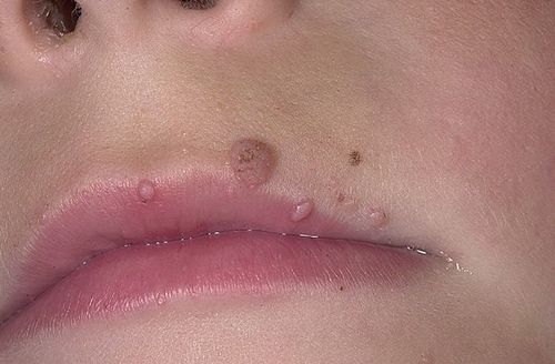 Слизистая - излюбленное место папиллом. Поэтому на губе они встречаются чаще всего.