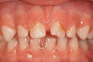 ФОТО: зубы у ребёнка в 3 года. Промежутки между зубами.