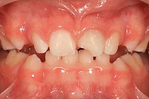 ФОТО: Зубы у ребёнка в полтора года. Сломался молочный зуб.