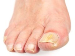 Эффективное лечение грибка ногтей на ногах народными средствами, в домашних условиях