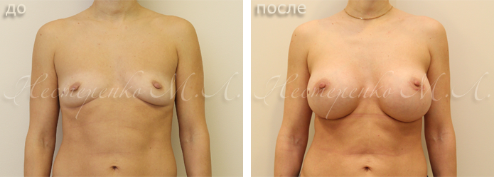 Фото пациентки до и после увеличения груди. Пластический хирург Нестеренко М.Л.
