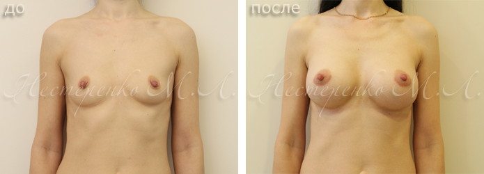 Фото пациентки до и после увеличения груди. Пластический хирург Нестеренко М.Л.