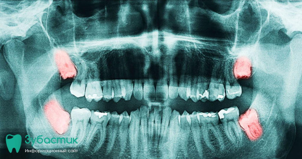Ренген снимок зубов которые растут в зуб.