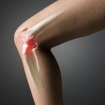 Эффективное лечение деформирующего артроза коленного сустава