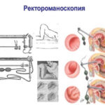 Ректроманоскопия