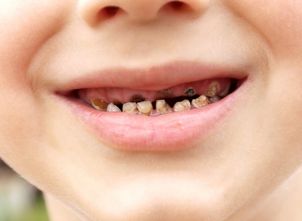 К чему снятся гнилые зубы: ответы и значения