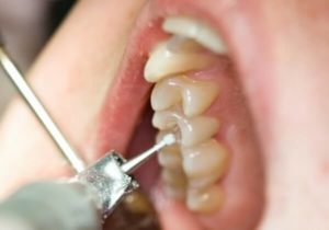 материалы для лечения зубов