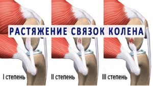 Степени растяжения связок коленного сустава