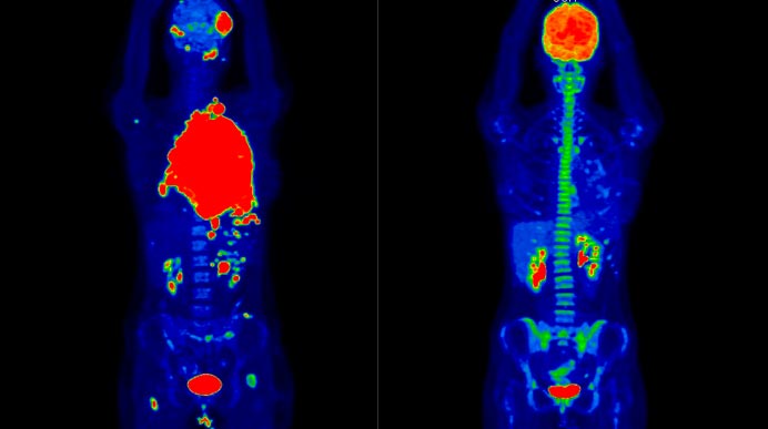 Пациентка 19 лет с диагнозом Диффузная В-крупноклеточная лимфома, изображение слева – результаты ПЭТ/КТ-исследования для оценки распространенности злокачественного процесса (красные области) перед началом лечения, справа – результаты после 2-х курсов химиотерапии.