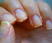 болезней ногтей на руках (2)-2