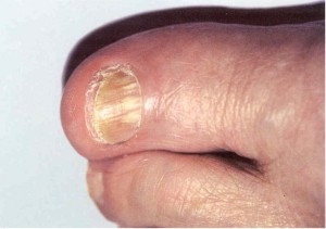 Пораженные грибком ногти